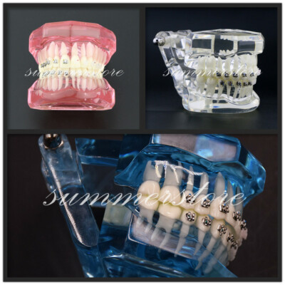 Modello Di Denti Ortodontici Con Staffa Per Bretelle In Ceramica - Foto 8