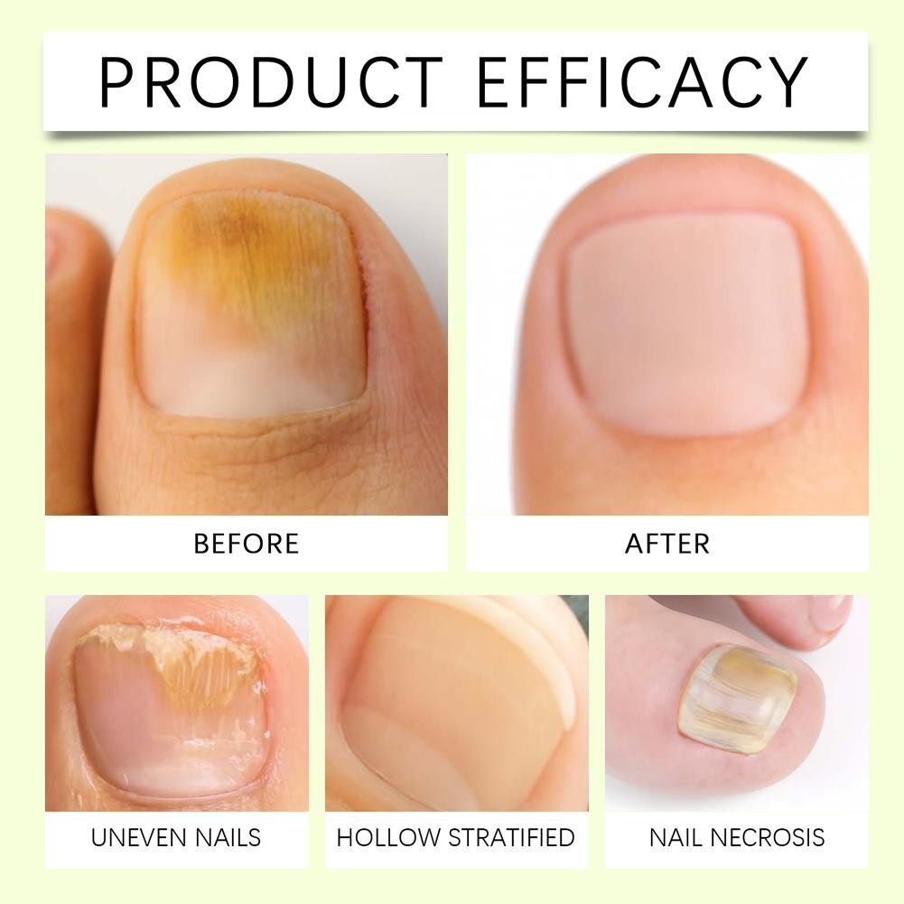 Ginger Nail Care Solution, Nail Soothing Liquid Help NEW Return Nails to Y2D1