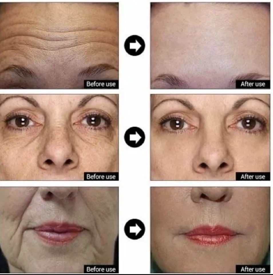 SORO Matrixyl 3000, 20% Argireline, vitamina C peptídeo ácido hialurônico rugas - - Imagem 2 de 3