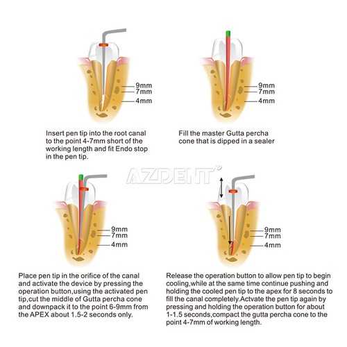 Sistema de obturación endodoncia dental pluma calentada/cortador de gutapercha - Imagen 29 de 49
