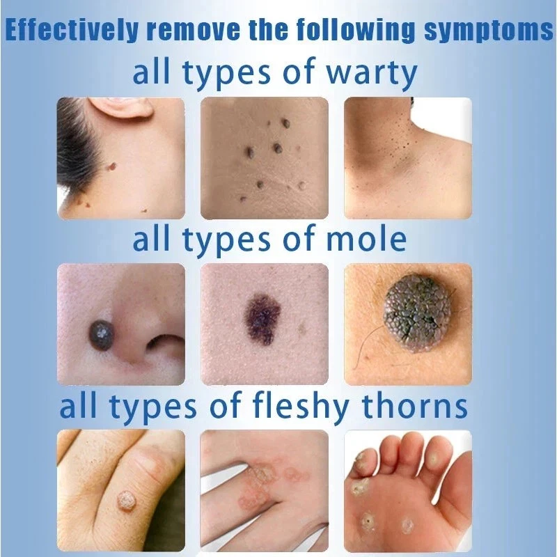 Crema removedora de etiquetas de verrugas y piel 20 g - Fórmula de extracto... - Imagen 4 de 4