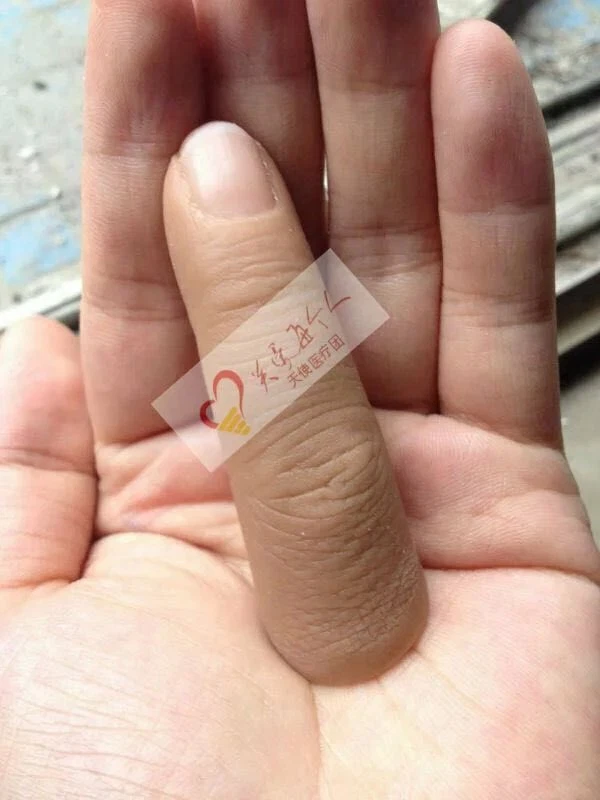 finger prosthetic finger prosthetics fingers prosthesis fingertip prosthesis - Image 3 of 4