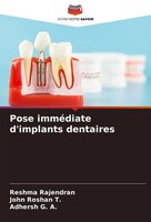 Reshma Rajendran (U. A.) | Pose ImméDiate D'implants Dentaires | Taschenbuch