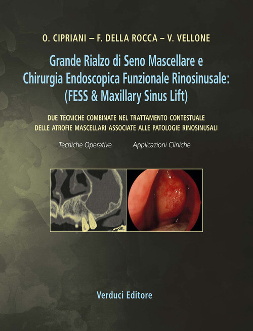 GRANDE RIALZO DI SENO MASCELLARE E CHIRURGIA ENDOSCOPICA FUNZIONALE RI AA.VV.