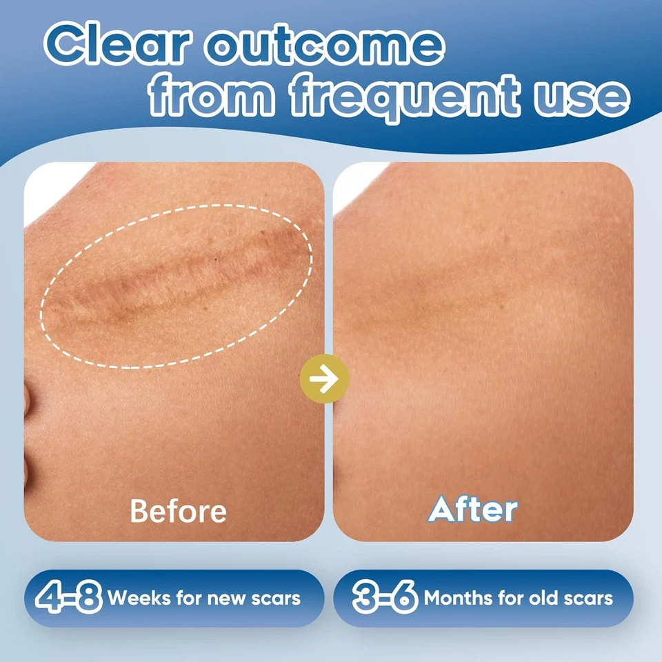 Advanced Silicone Scar Gel for Face & Body – Silicone Gel Cream for Old & New - Image 4 of 4