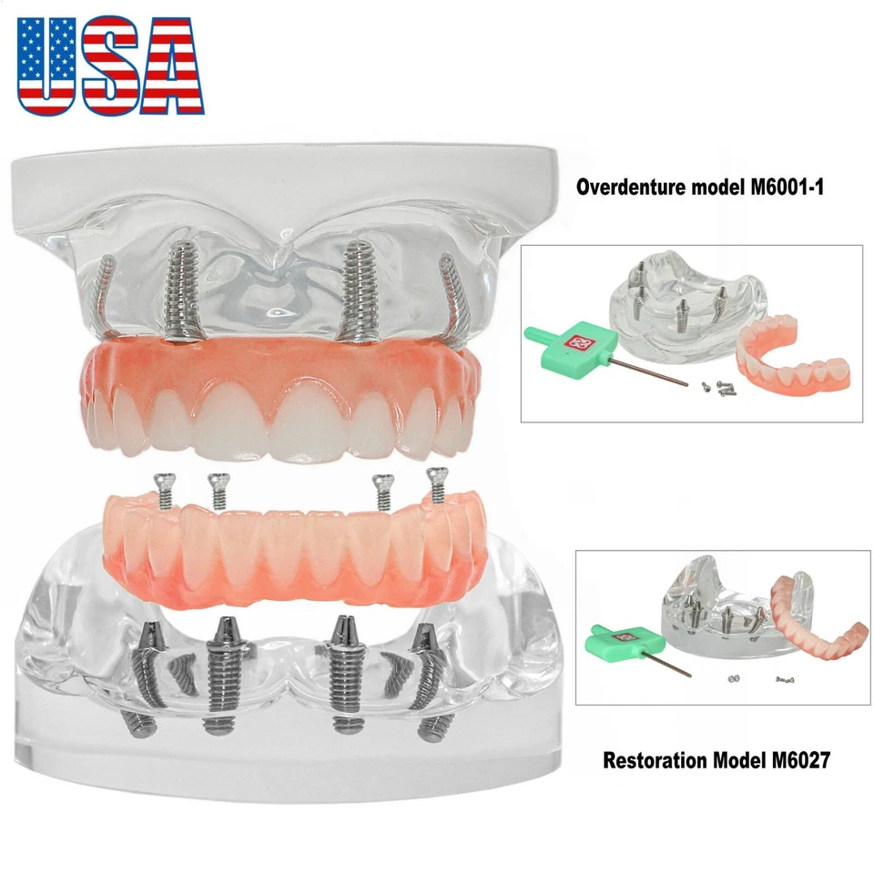 US Dental All-on-4 Implant Model Upper/Lower Jaw-Clear With 4 Screws Overdenture - Image 2 of 4