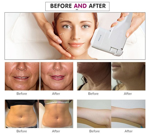 beauty salon equipment skin tightening 2D 3D anti aging facial machine + 5 tip - Picture 9 of 9