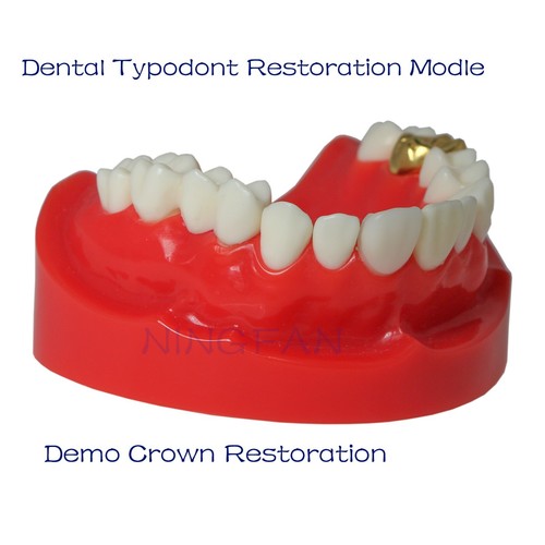 Dental Restorations Model Upper/Lower Jaw Onlay/Crown/Veneer/Bridge Removable - Picture 10 of 11