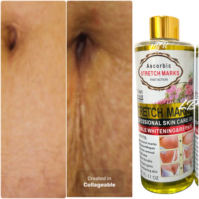 Ascorbic stretch-mark Oil,Body Oil For Scars & Stretch marks,oil Hydrates,Fades