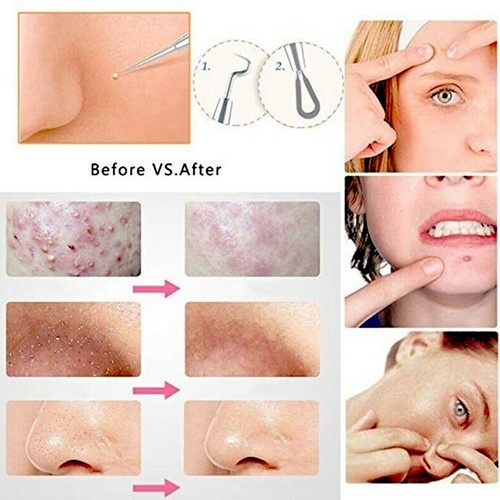 Pimple Remover Tool Kit Blackhead Extractor Comedone Acne Spot Popper 9 Pcs Tool - Bild 4 von 7