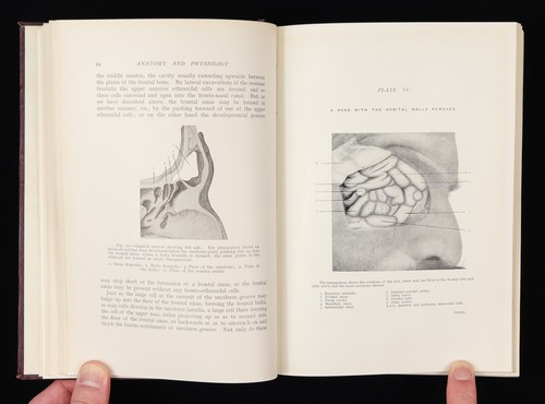 1910 Medical Textbook Diseases of The Nose - Picture 14 of 21
