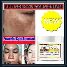 Dark Skin Whitening Dark spot Brightening Bleaching Lightening FAST RESULTS.