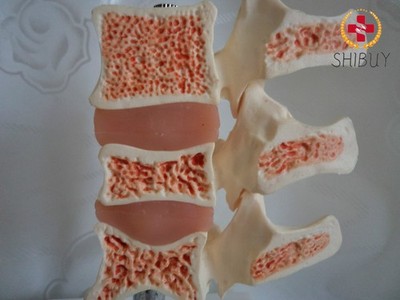 1pc Human Anatomical Spine Bone Spinal Typical Lesion Model