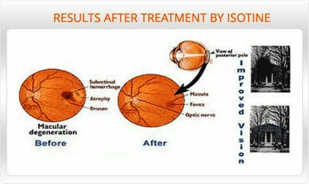Share Similar Items Sponsored See all   Cataract Eye Drops OFFICIAL  Pack of 2