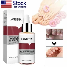 LANBENA Nail Repair Essence Serum Fungus Removal Feet Anti Infection Paronychia