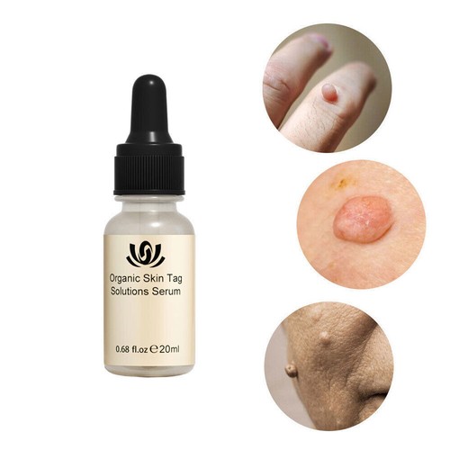 12-Hours Wart Remover Skin Tag Mole Remover Eliminate Foot Corn Wart Liquid 20ml - Picture 6 of 12