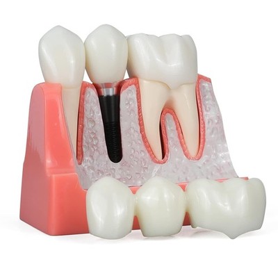 ANNWAN Dental Implant Model 4 Times Removable Analysis Crown Bridge... 