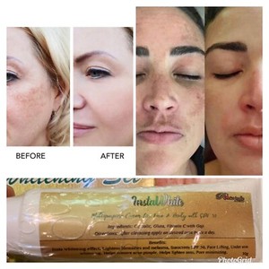cream for melasma on face