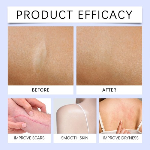 1-5X Silicone Scar Gel Stretch Marks Removal Cream Advanced Surgery Scar Care - Picture 2 of 16
