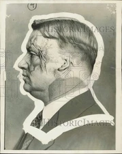 1927 Press Photo Thomas Murtagh after explosion that left him disfigured
