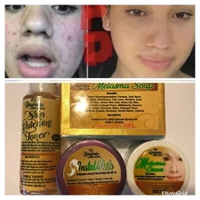 Melasma Set Whitening Glowing Skin Remove Dark Spot Acne Pimples