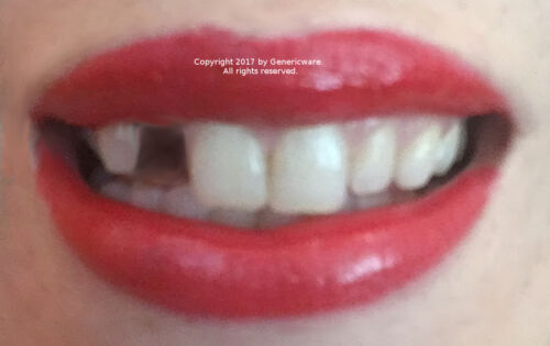 Temporary tooth repair kit, dental fix temp - triple qty - 36 teeth- Free video! - 第 1/2 張圖片