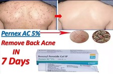  PACK OF 2 New Pernex AC 5 Gel Benzoyl Peroxide For Back Acne  Pimple 20GM