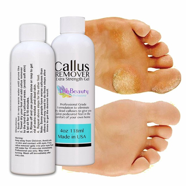 Best Callus Remover.Callus Eliminator,Liquid Gel For Corn And Callus On