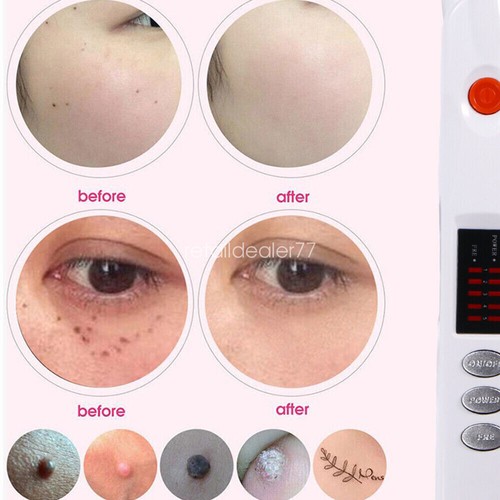 Beauty Monster Plasma Pen Fibroblast Eye Skin Care Scar Freckle Moles Removal - Picture 4 of 12