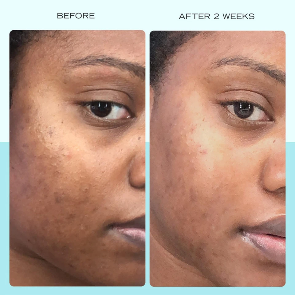 First Aid Beauty - Suero para manchas oscuras con niacinamida, ayuda a reducir el aspecto de Dar... Foto 3 de 4