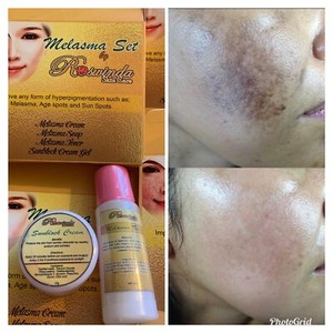 toner for melasma