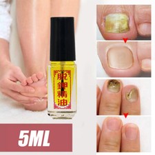 Nail-Removal Essential Oil Removal of Onychomycosis Paronychia Anti-Fungus Oil