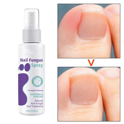 Zehennagel und Handnagel Reparatur Spray 3,4 flüssige Unzen für verfärbte und beschädigte Nägel