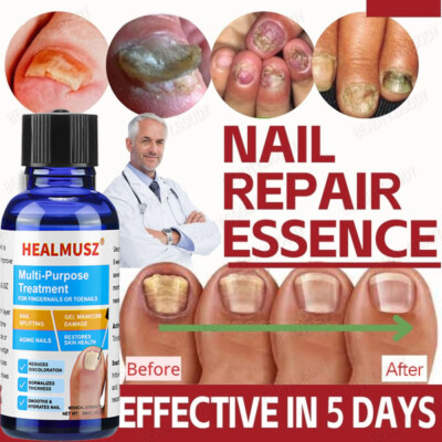 Extra Strength Toenail Fingernail Fungus Treatment Nail Repair Renewal Solution