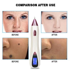 Anti-Aging Electric Plasma Pen Spot Removal Dark Spot Remover Skin Care Machine