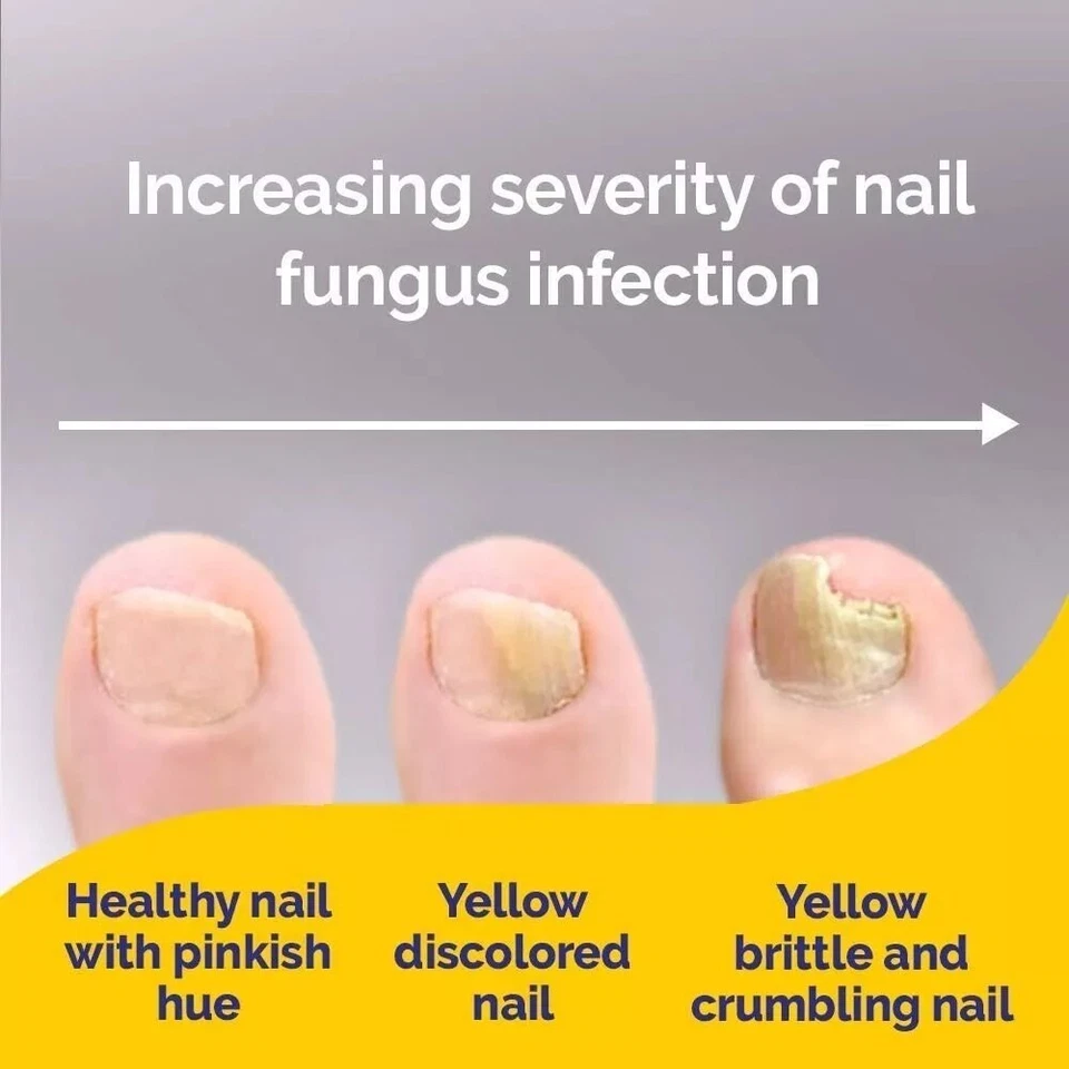 Schollmed Once Weekly Fungal Nail Treatment Clinically Proven With Amorolfine - Image 2 of 4