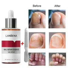 LANBENA Nail Repair Remove Onychomycosis Serum Fungal Nail Treatment Essence 15g