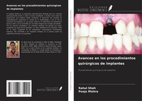 Avances En Los Procedimientos QuirúRgicos De Implantes Rahul Shah (U. A.) Buch