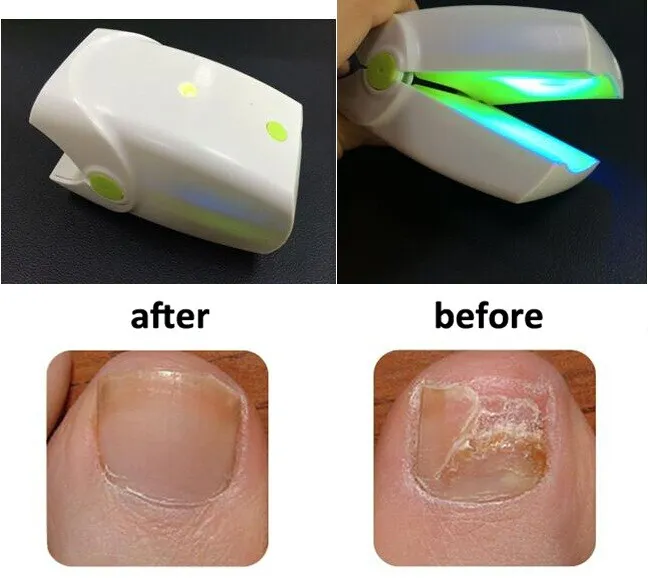 Nail Fungus Laser Treatment Device,LED Light Max Strength Repair for  Damaged Discolored Thick or Brittle Nails,Restoring Healthy Nails - Nail  Health Care : Amazon.ca: Beauty & Personal Care