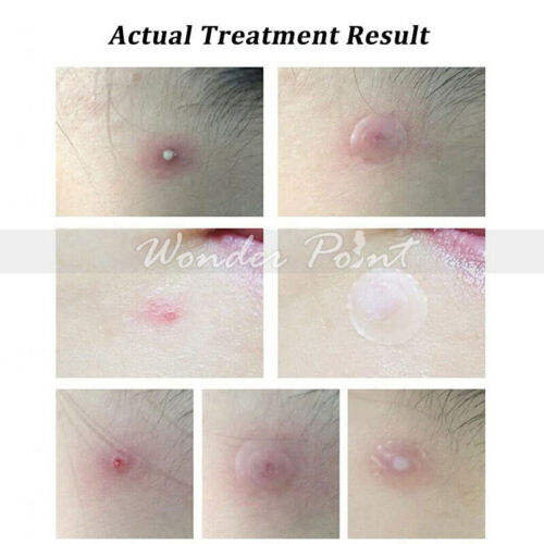 36pcs Acne Dots Pimple Patches Cystic Acne Patch Hydrocolloid Acne Spot Sticker - Picture 11 of 12