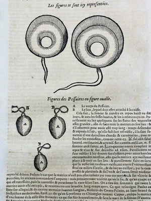 Gynécologie 1614 Obstétrique Pessaire Fécondité Hymen Gravure Ambroise Paré - Photo 1/4