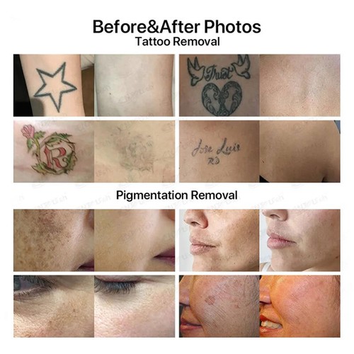 Pico Laser Tattoo Removal Beauty Salon Eyebrow Pigment Dark Spot Removal Machine - Picture 8 of 17