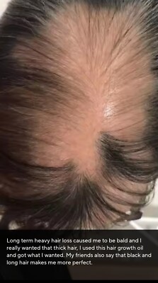 Hair grow Essentials Oil This Is The Latest Research Result, Can Grow Hair Anywh