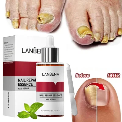 LANBENA Ginger Antibacterial Fungal Nail Treatment Nail Repair Essential Oil Serum 15ml