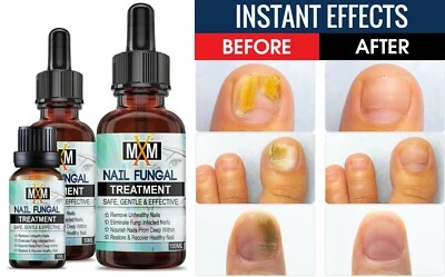 2021 Fungal Nail Treatment Highly Effective Kill Nail Fungus For Best Result UK