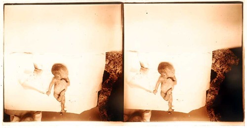 photographies 13 STÉRÉOS MÉDICALES GYNÉCOLOGIE vers 1900 - 1920 - Imagen 9 de 24