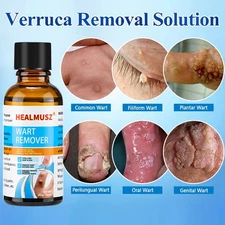 Wart Remover Fast Acting and Painless Mole Remover,Wart Remover for Face Skin
