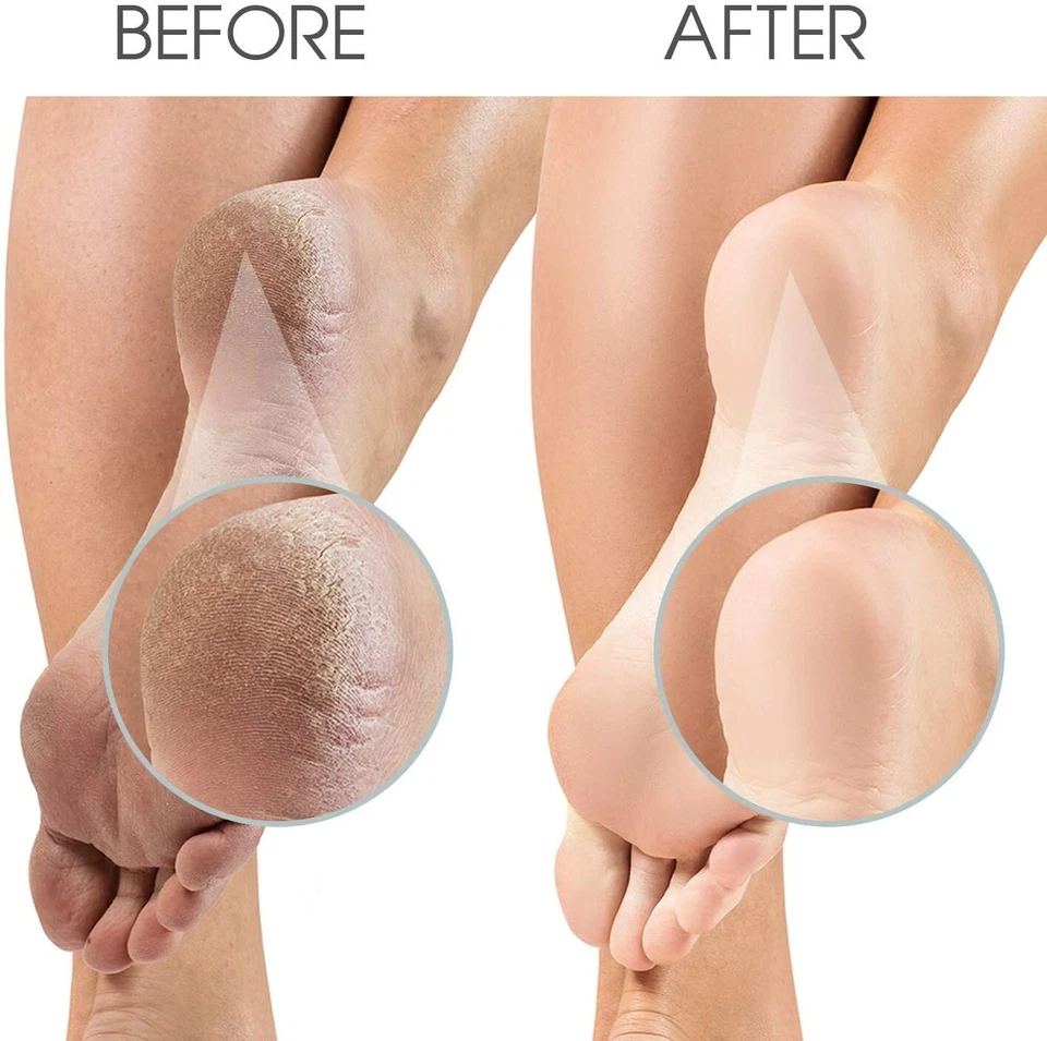 Double Sided Foot File Feet Rasp Pedicure Scrubber Hard Dead Skin Callus Remover - Image 2 of 4