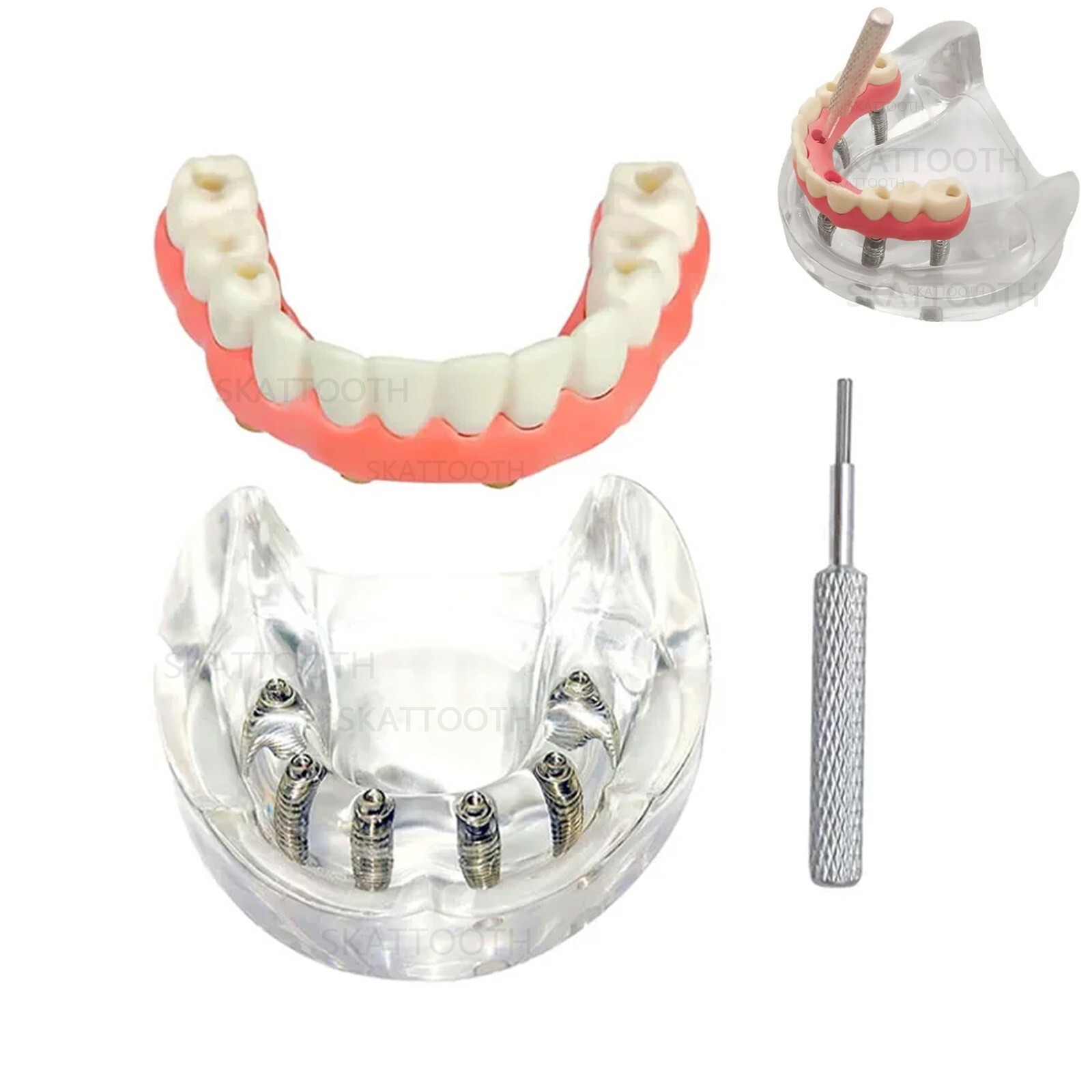 Implant-Supported Overdentures: Advanced Denture Treatment