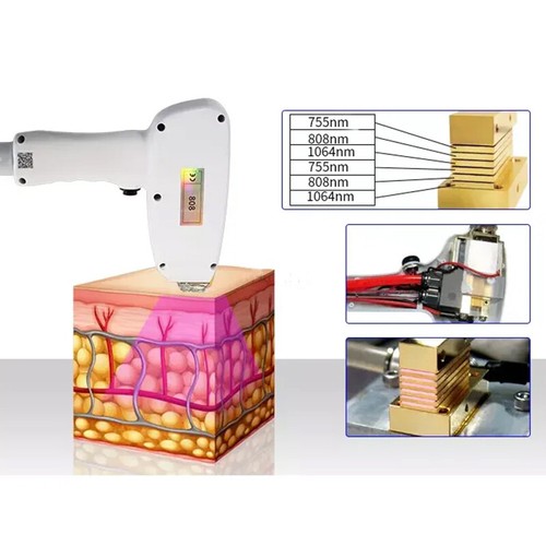 755nm 808nm 1064nm Diode Laser 3 Wave Length Hair Removal Machine Full Face Body - Picture 17 of 19